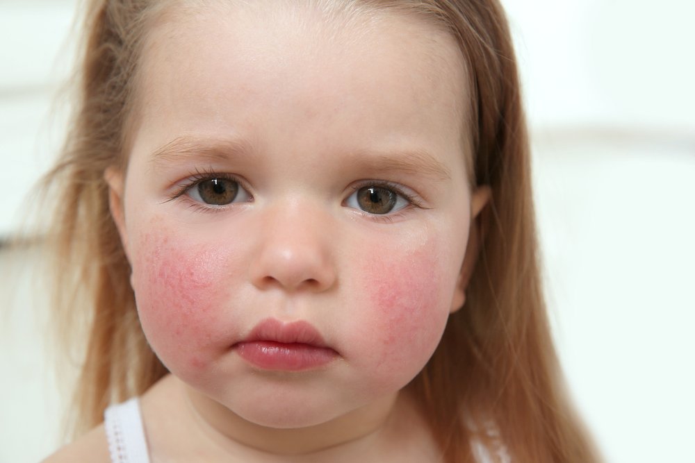Инфекционное покраснение кожи у детей
