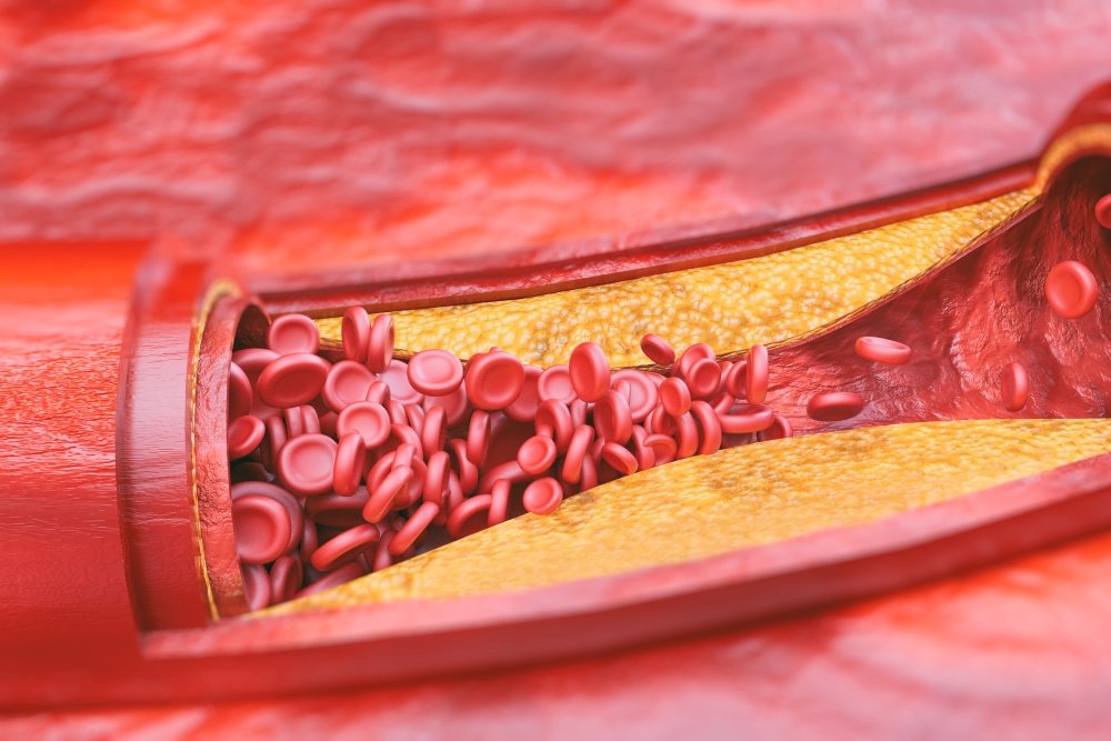 Возможные причины атеросклероза коронарных артерий