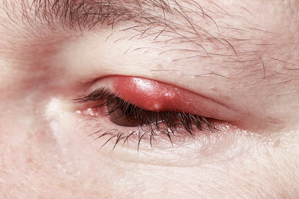 Ячмень на глазу: опасное воспаление