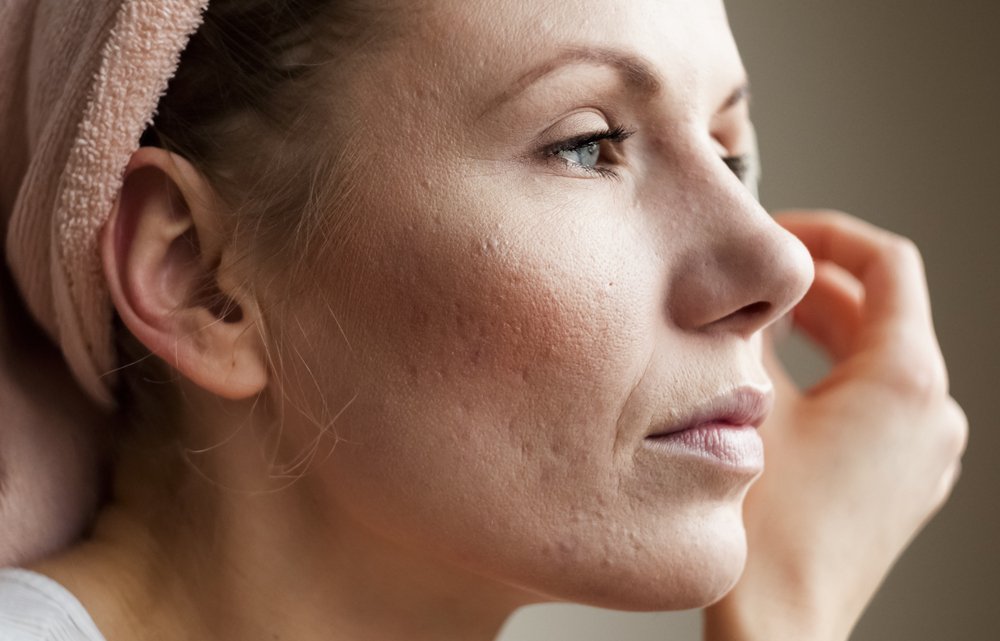 Причины возникновения угревой сыпи на коже лица