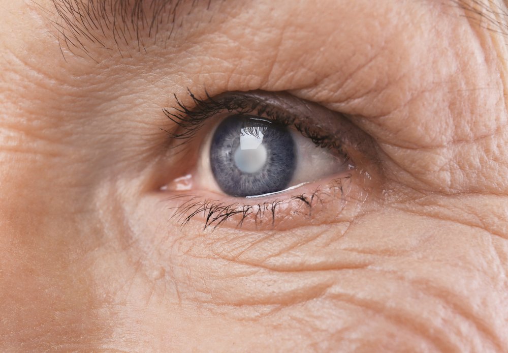 Почему развивается катаракта?