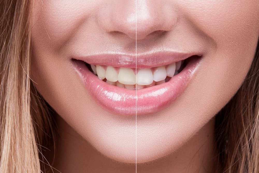 «Отбеливайте зубы каждые 6-12 месяцев»