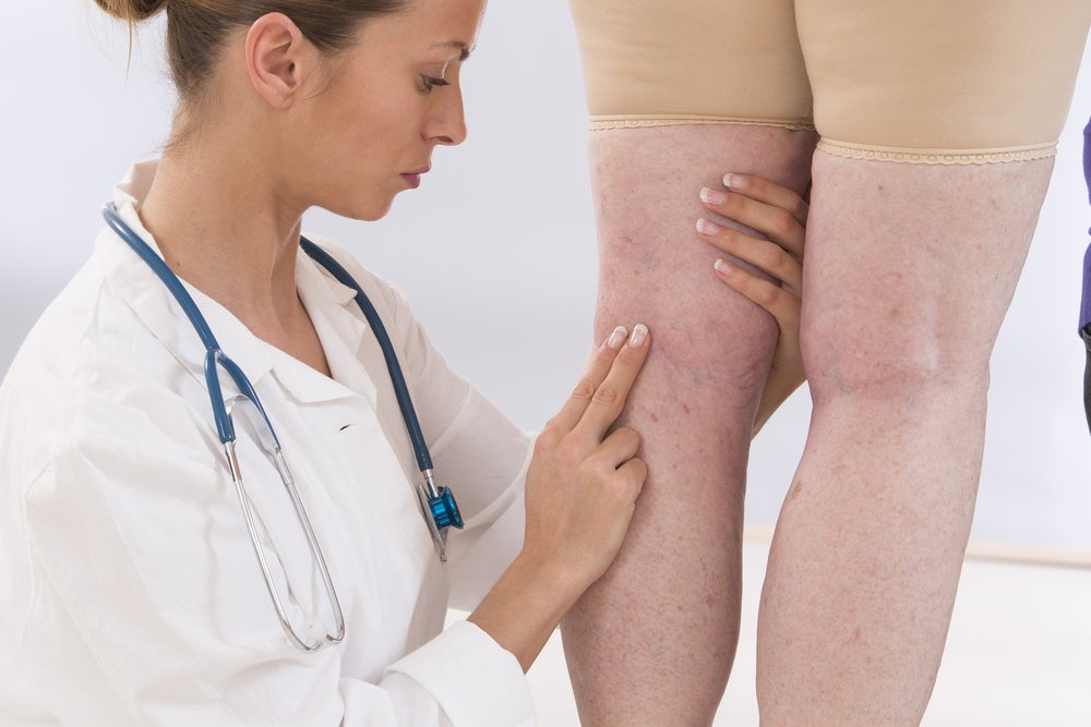Симптомы и лечение расширенных вен на ногах: используемые лекарства