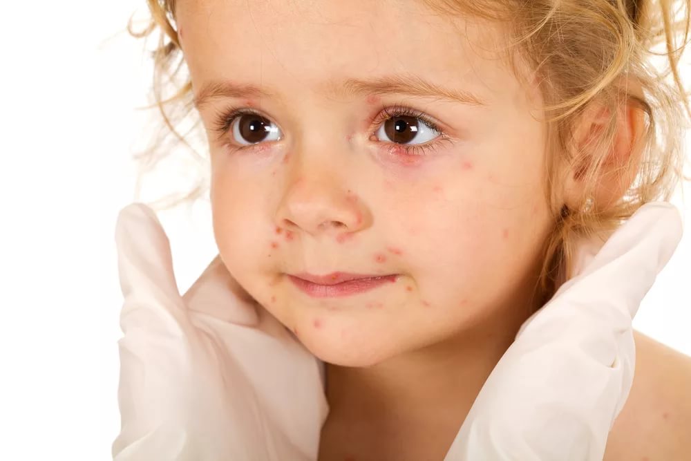 Механизм возникновения аллергии у детей