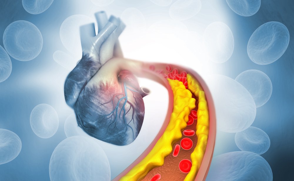 Поражение сосудов сердца: механизм провокации инфаркта миокарда