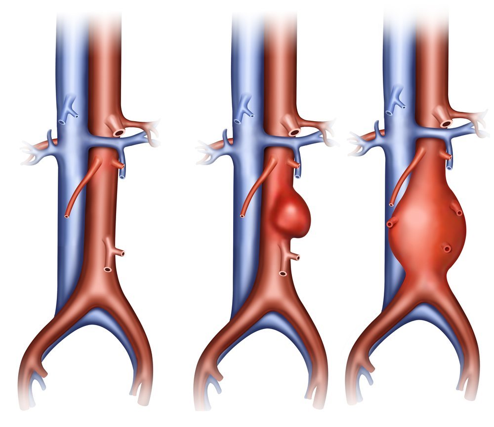 Причины аневризмы: атеросклероз артерий, врожденная патология