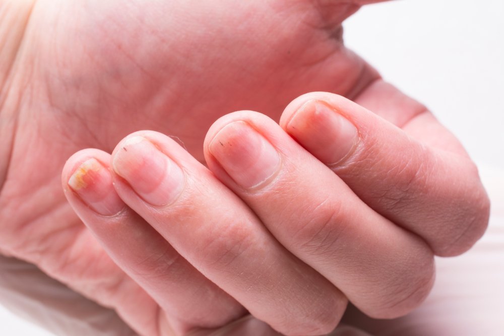 Дистрофические процессы: поражение ногтей и окружающей кожи