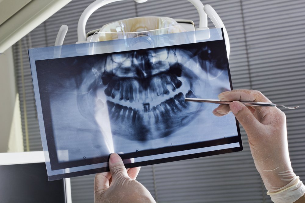 Имплантация зубов — подготовительный период
