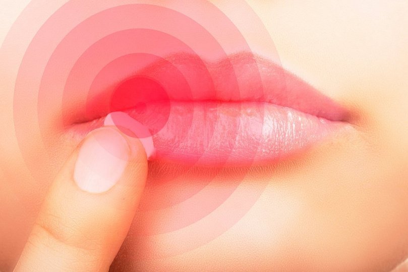 Как выглядит простуда на губах и как ее лечить Как выглядит простуда на губах и как ее лечить