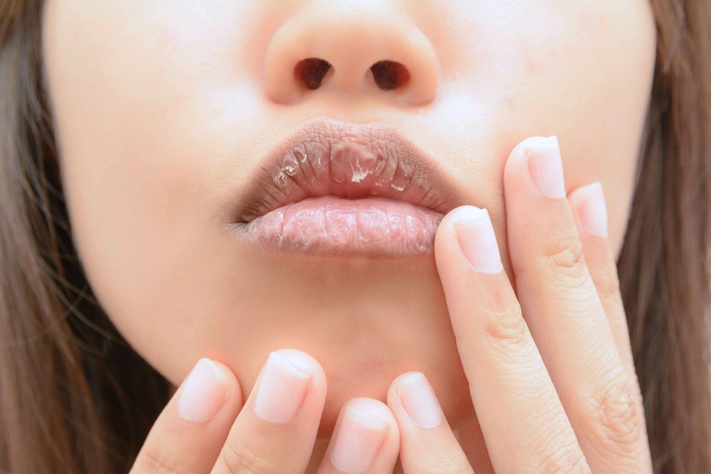 Причины проблем с губами: сухой воздух или нехватка витаминов?