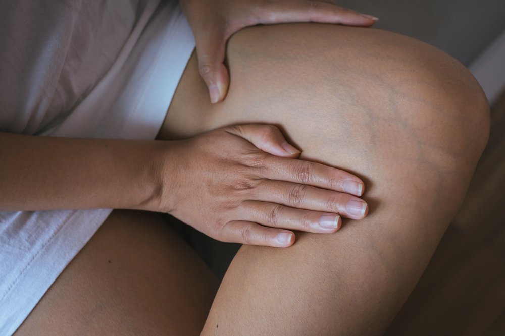 Беременность и варикоз: причины