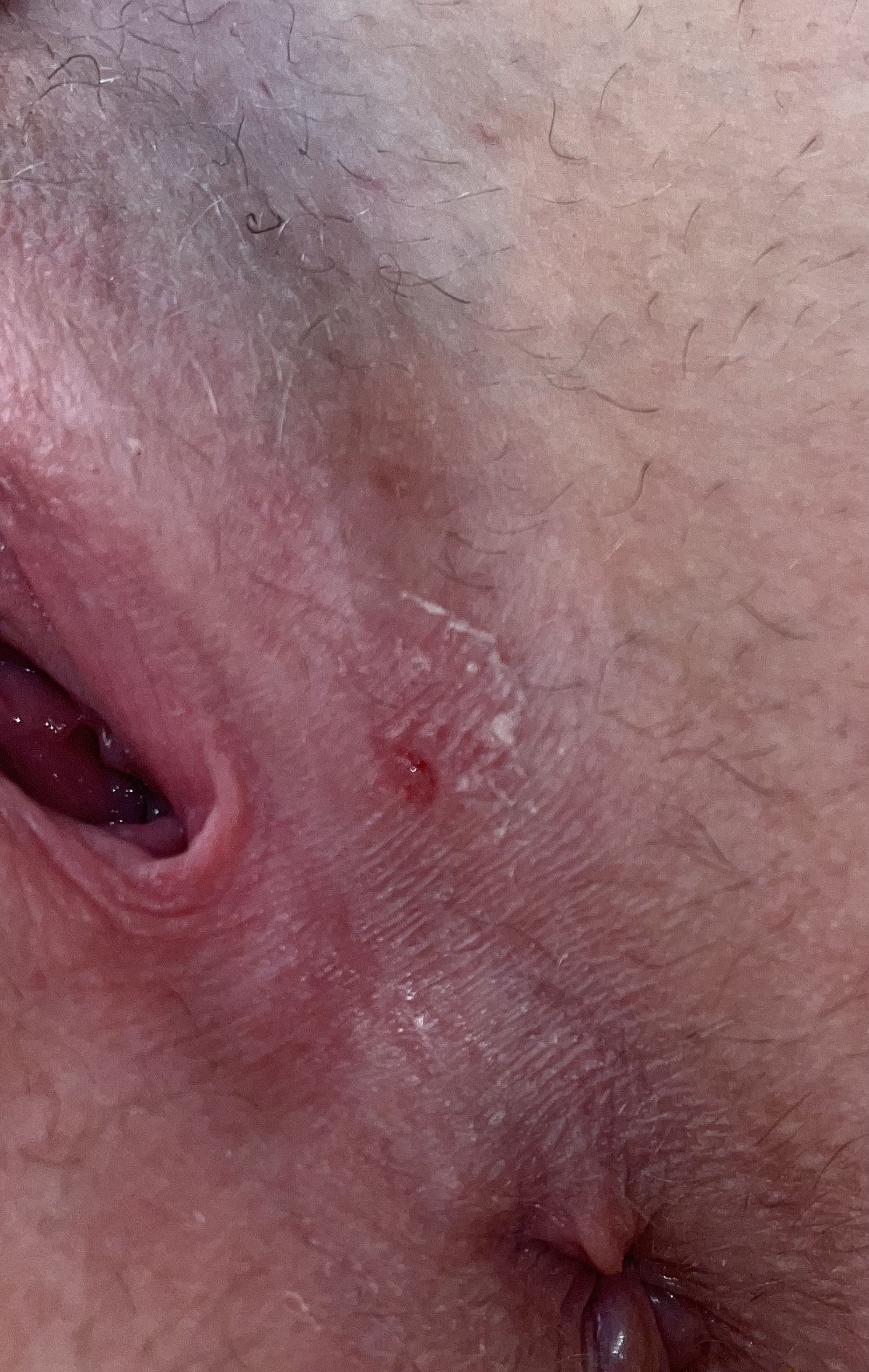 сифилисом можно заразится от мастурбации фото 4