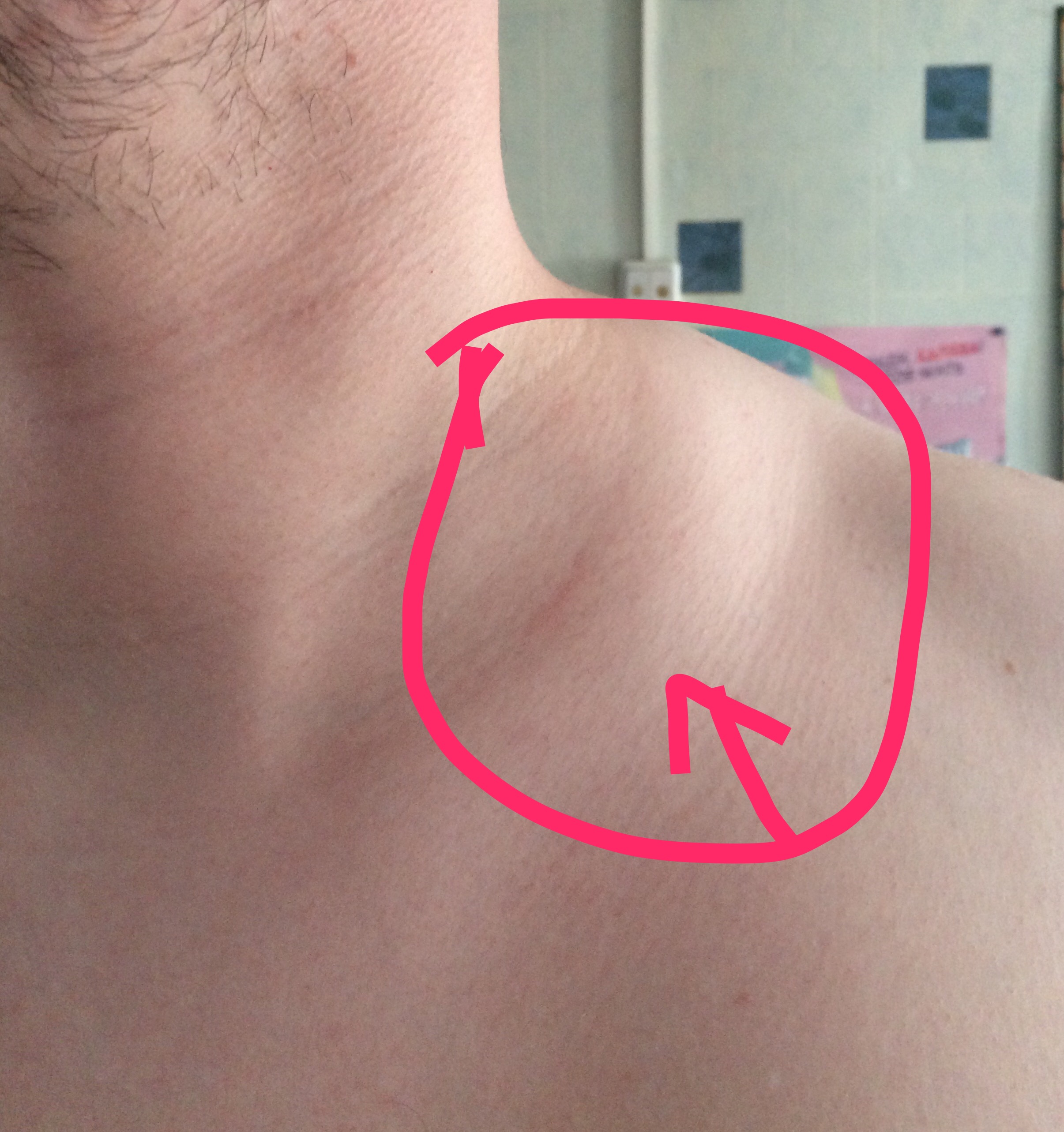 уплотнение под кожей на груди у мужчин фото 48