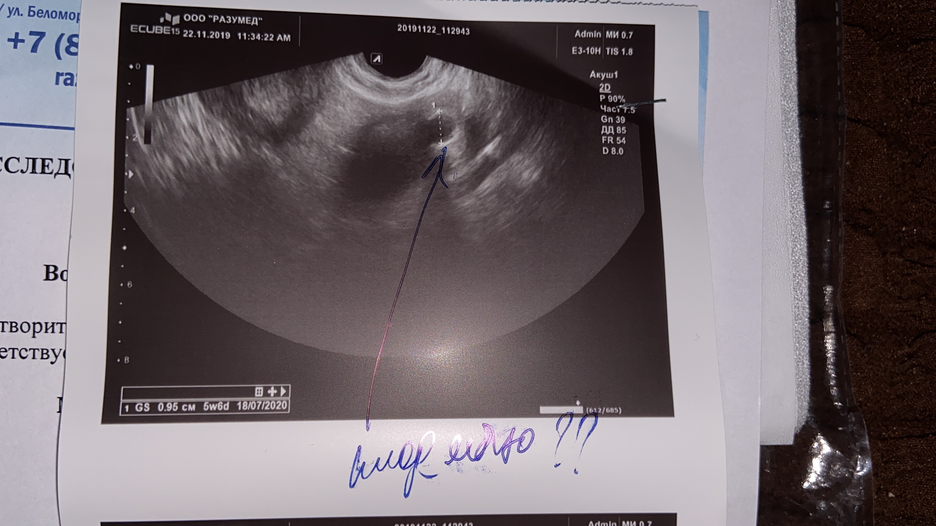 грудь при беременности внематочной беременности на раннем сроке (120) фото
