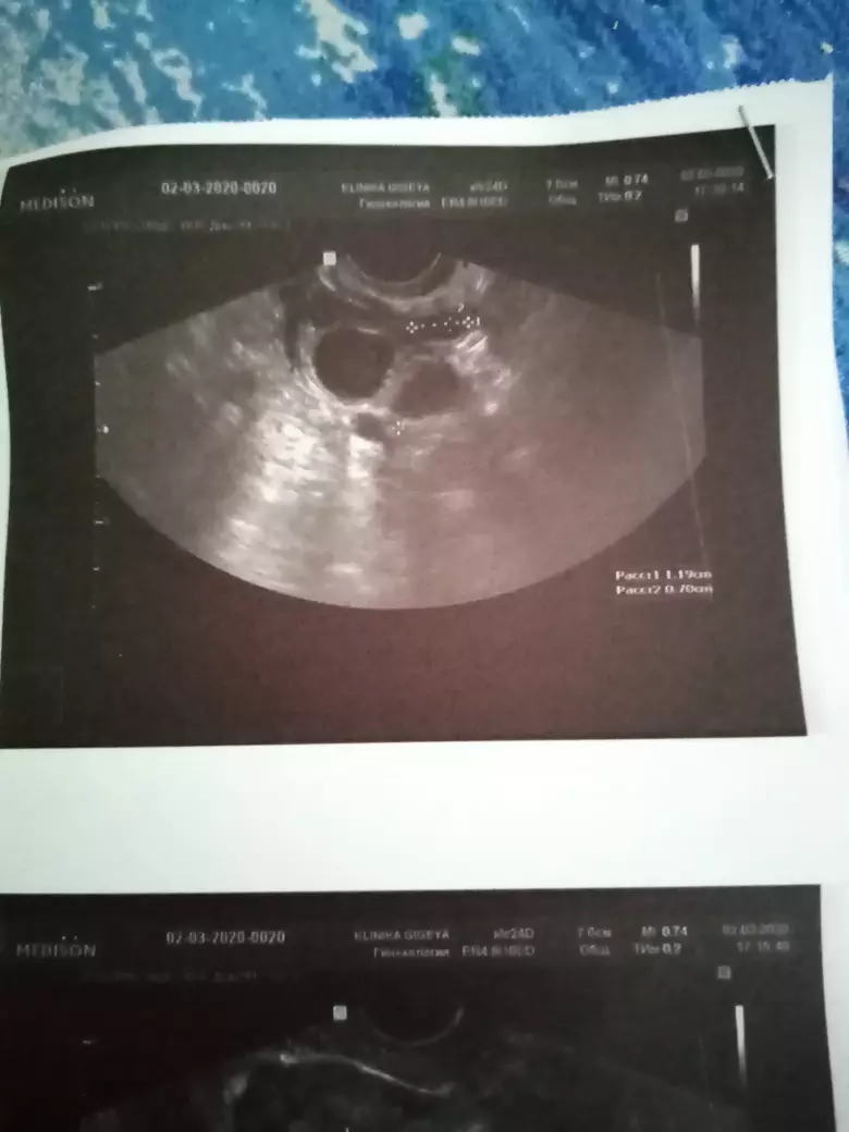 Возможно ли забеременеть? Расшифровать и скажите возможно ли ...