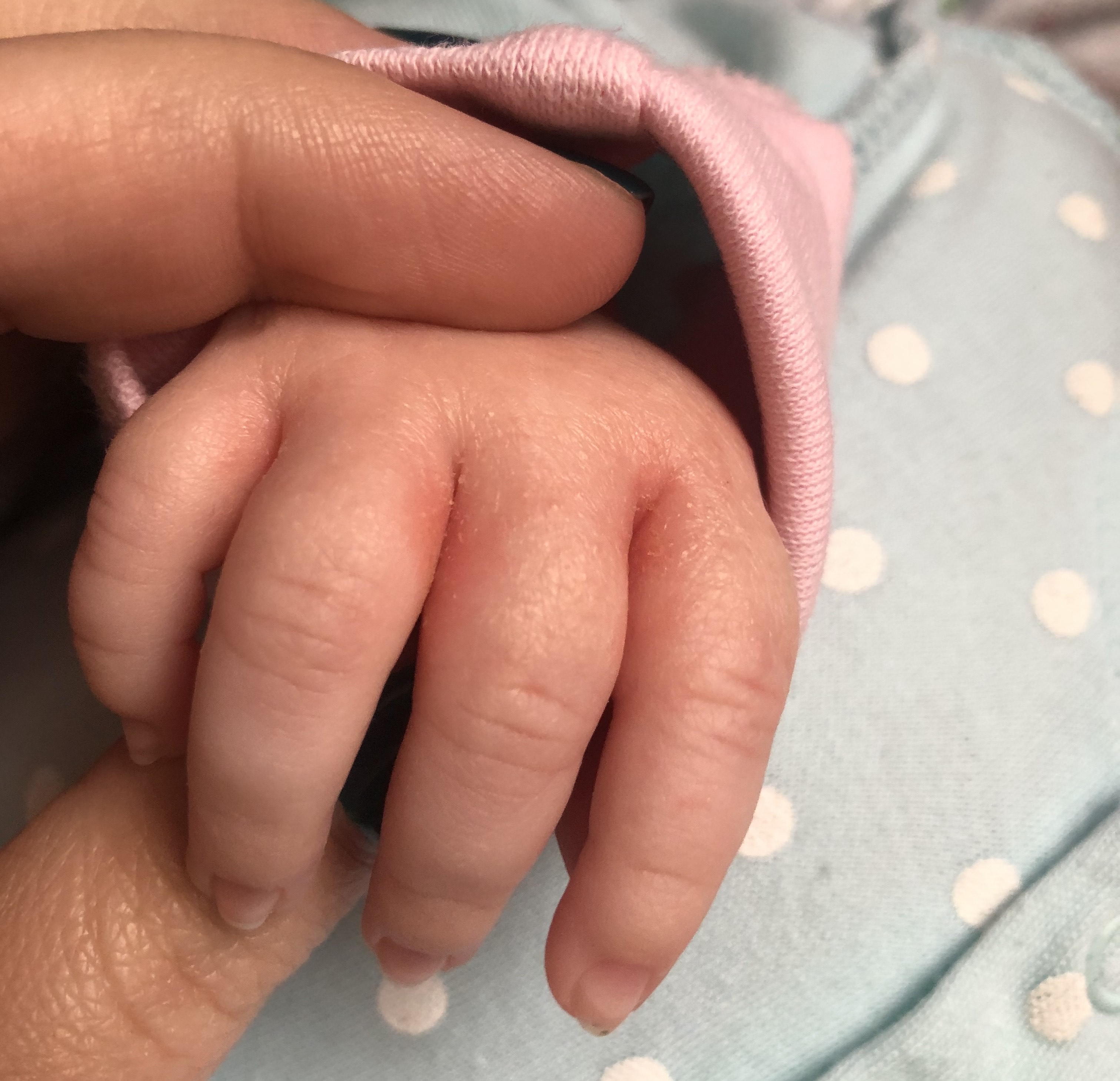 Сыпь между пальцами у ребенка