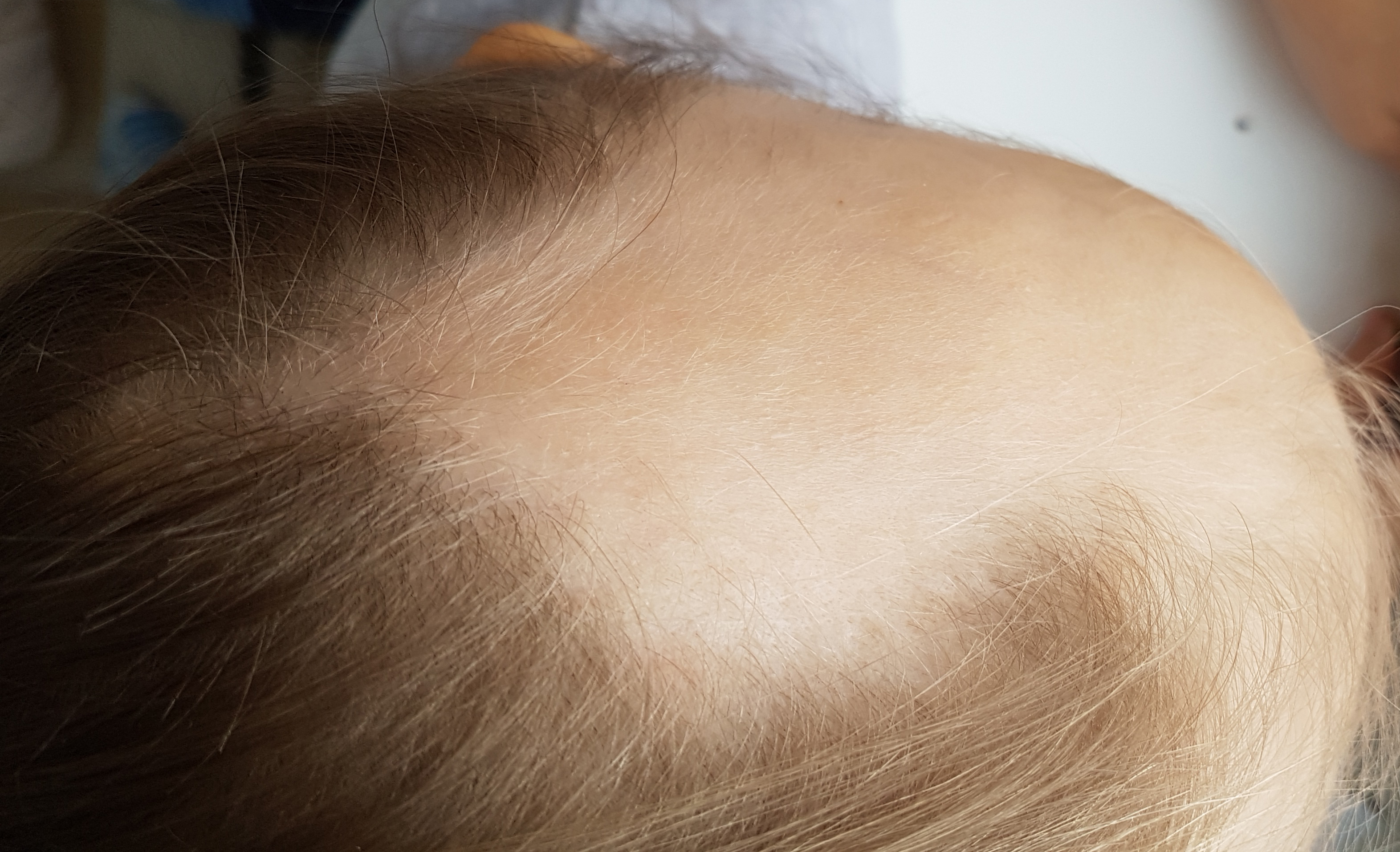 Из за чего у детей выпадают очагами волосы на голове