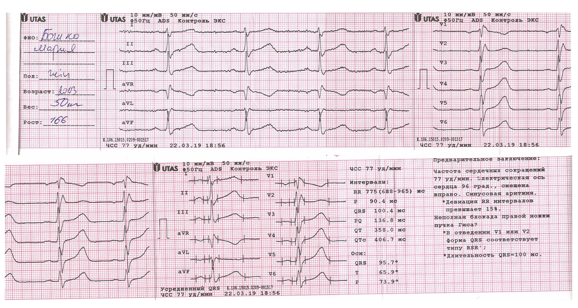 Экг сочи. Кардиограмма сердца норма показатели. QRS норма ЭКГ. ЭКГ P(MS) 105. ЭКГ зубец р в норме и при патологии.
