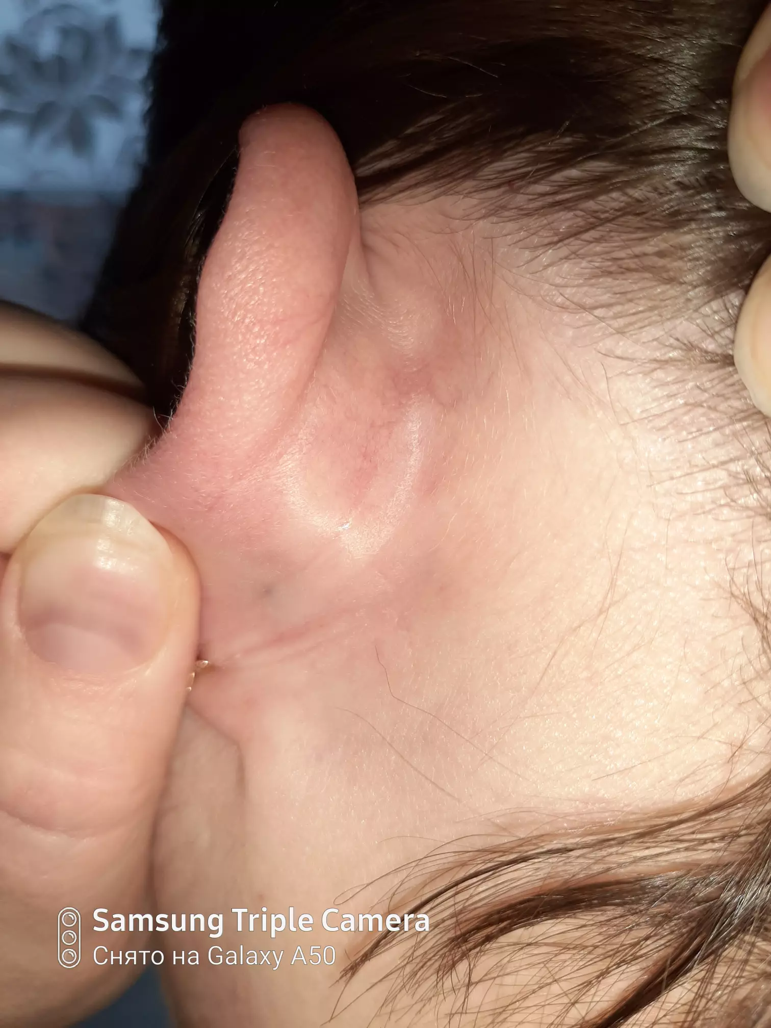 Почему появляется шишка за ухом, и как от нее избавиться