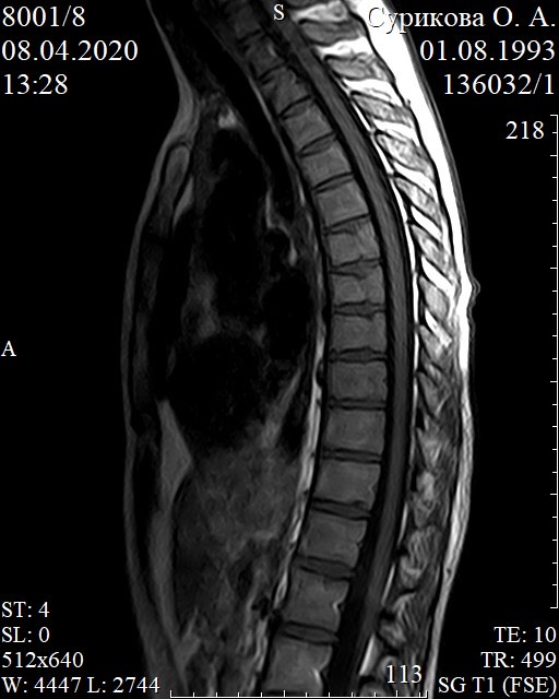 Мрт грудного отдела позвоночника. Мрт грудного отдела. Снимок мрт грудного отдела. Снимки мрт грудного отдела. Остеохондроз грудного отдела мрт.