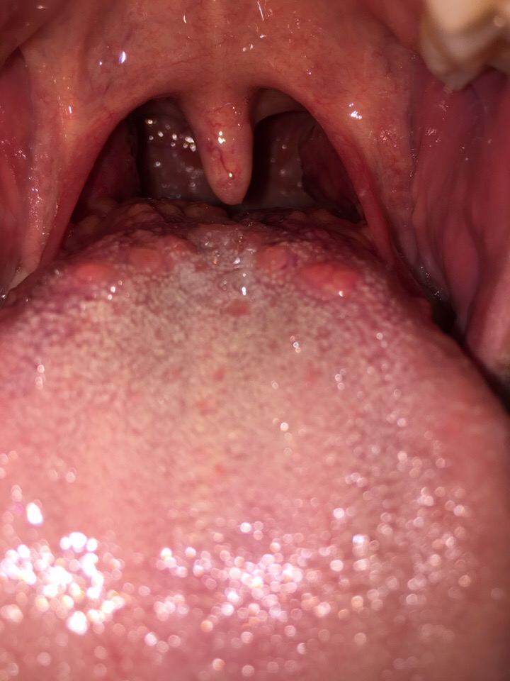 Воспаление под языком