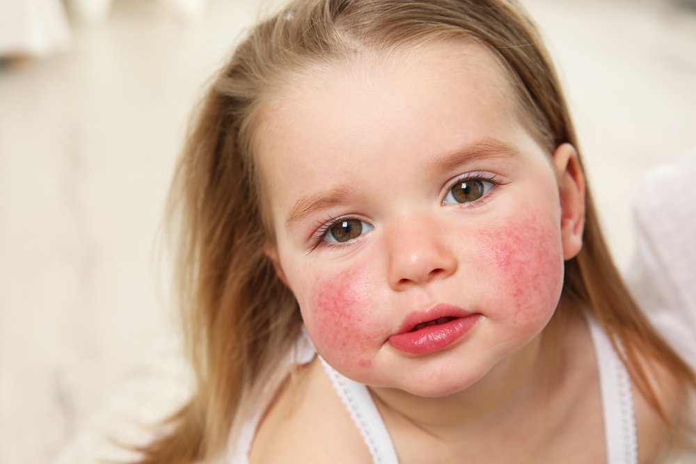Что нужно знать о генетике аллергии