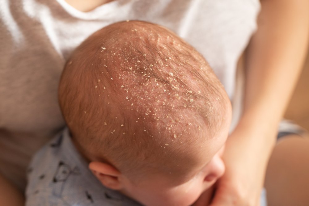 Молочные корочки на голове у ребенка: причины появления, лечение, профилактика