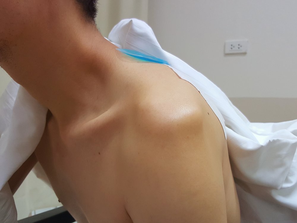 Какие признаки указывают на вывих плеча?