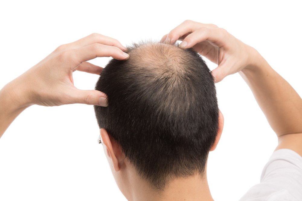 Как остановить выпадение волос у мужчины витамины