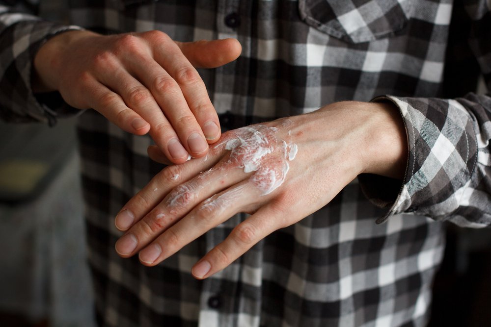 Уход за кожей при экземе и псориазе: увлажнение снятие зуда