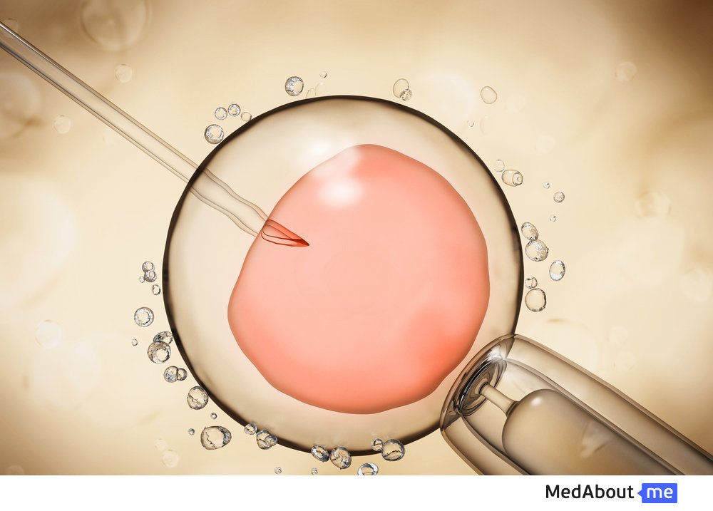 ИКСИ (Инъекция сперматозоидов в цитоплазму яйцеклетки)