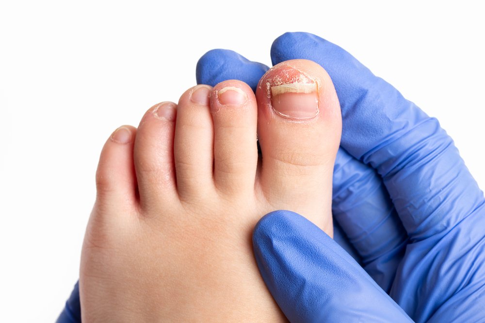 Как лечится онихомикоз: лечение грибка ногтей у детей