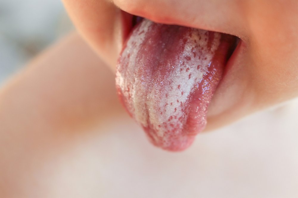 Причины возникновения молочницы у ребёнка во рту