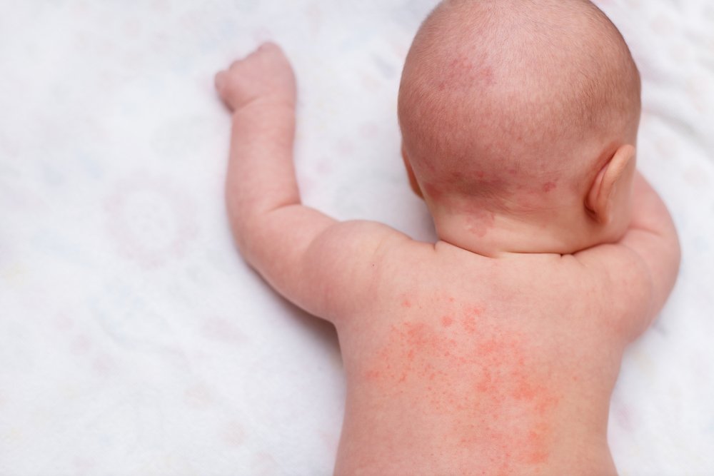 Что вызывает аллергию у ребёнка?