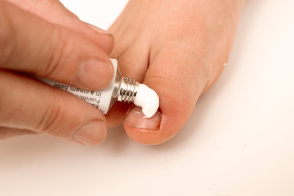 Лечение инфекции ногтей в домашних условиях