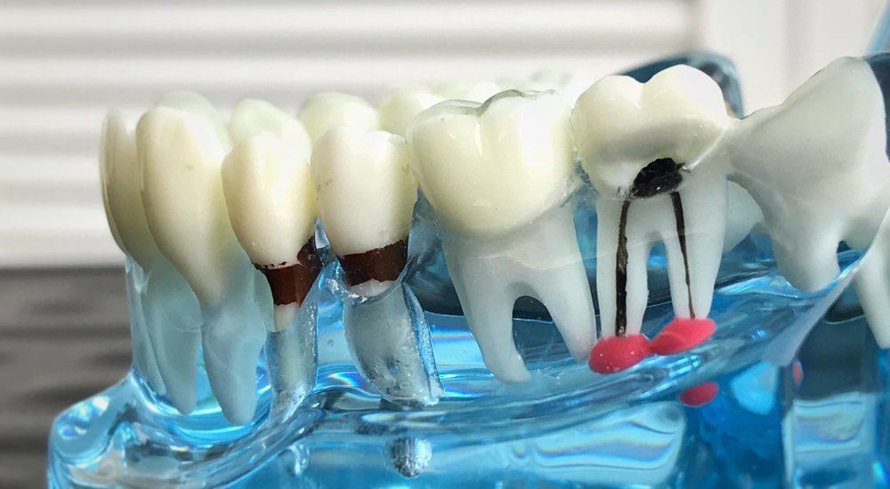 Абсцесс зуба: общие данные