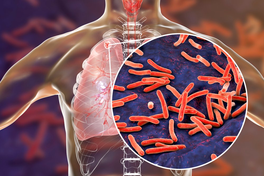 Туберкулез: заражение опасной инфекцией