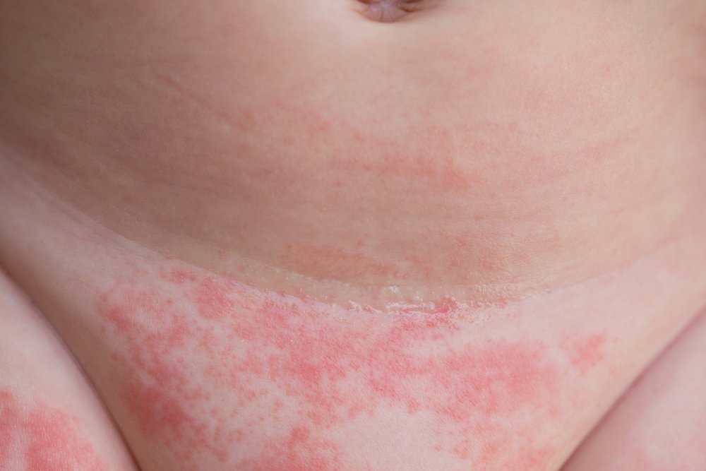 Пеленочный дерматит: как сказываются дефекты ухода на нежной коже?