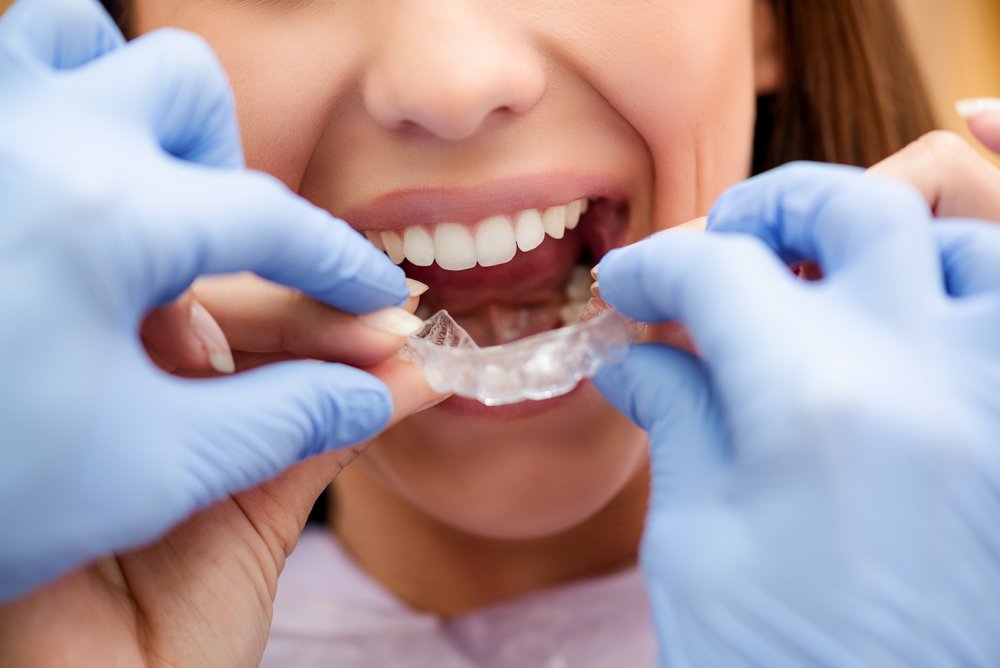 Ортодонтические пластинки в полости рта у детей