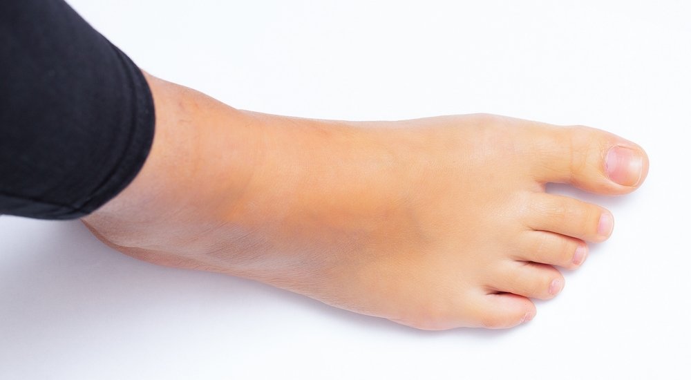 Причины и симптомы ригидности большого пальца стопы