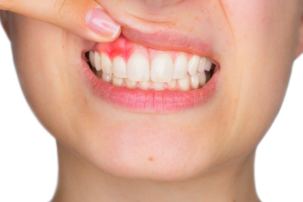 Киста на десне: причина в зубах
