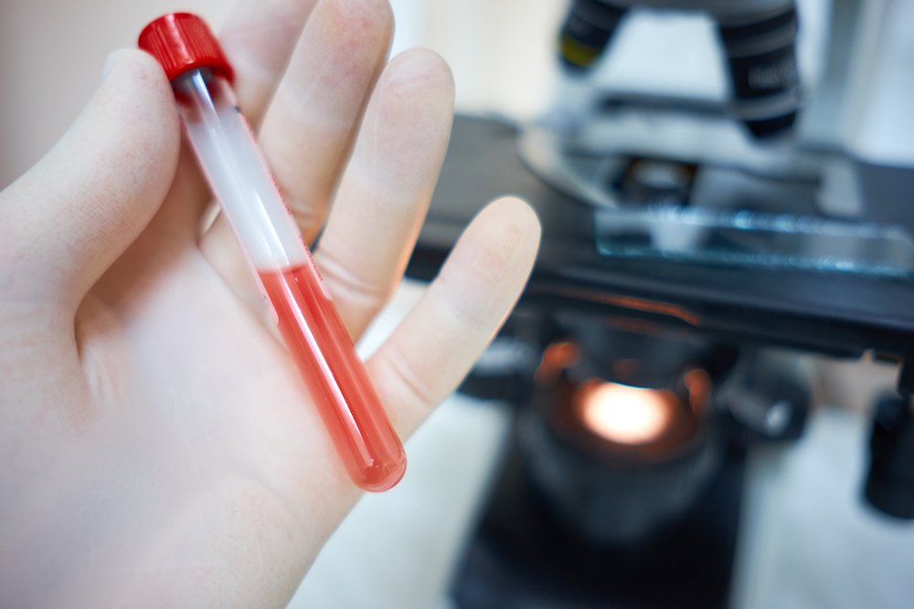 Что говорят врачи об анализе крови на «онкомаркеры»?