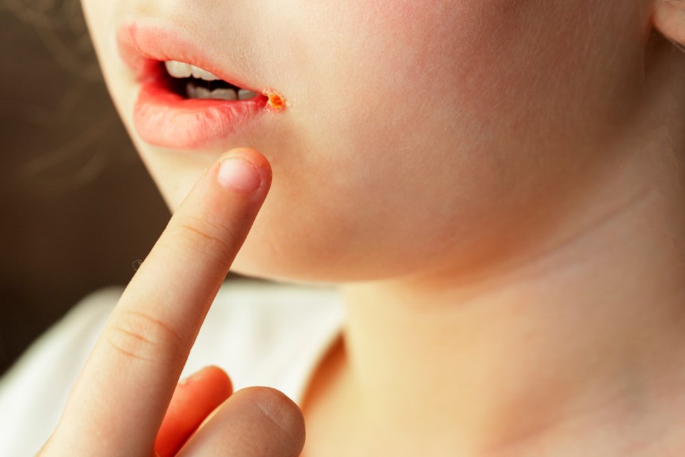 Заболевания языка и губ у детей и подростков