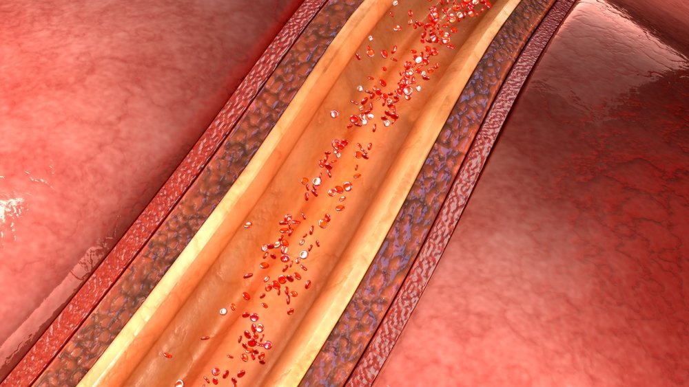 Классификация эссенциальной артериальной гипертензии