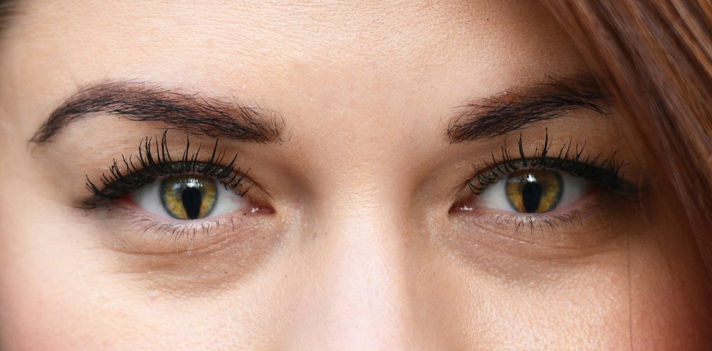 Синдром кошачьего глаза (колобома, синдром Шмида-Фраккаро)
