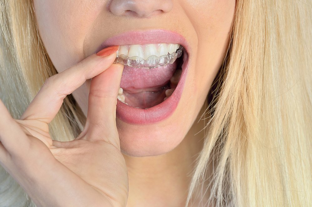 Самые опасные методы полупрофессионального отбеливания зубов