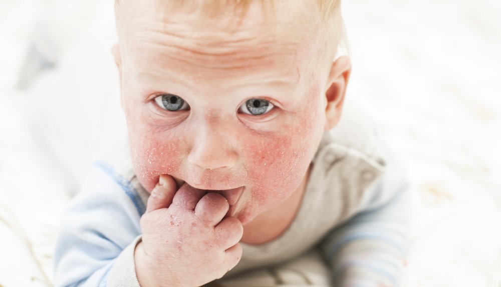 Изменения в жизни ребёнка с дерматитом