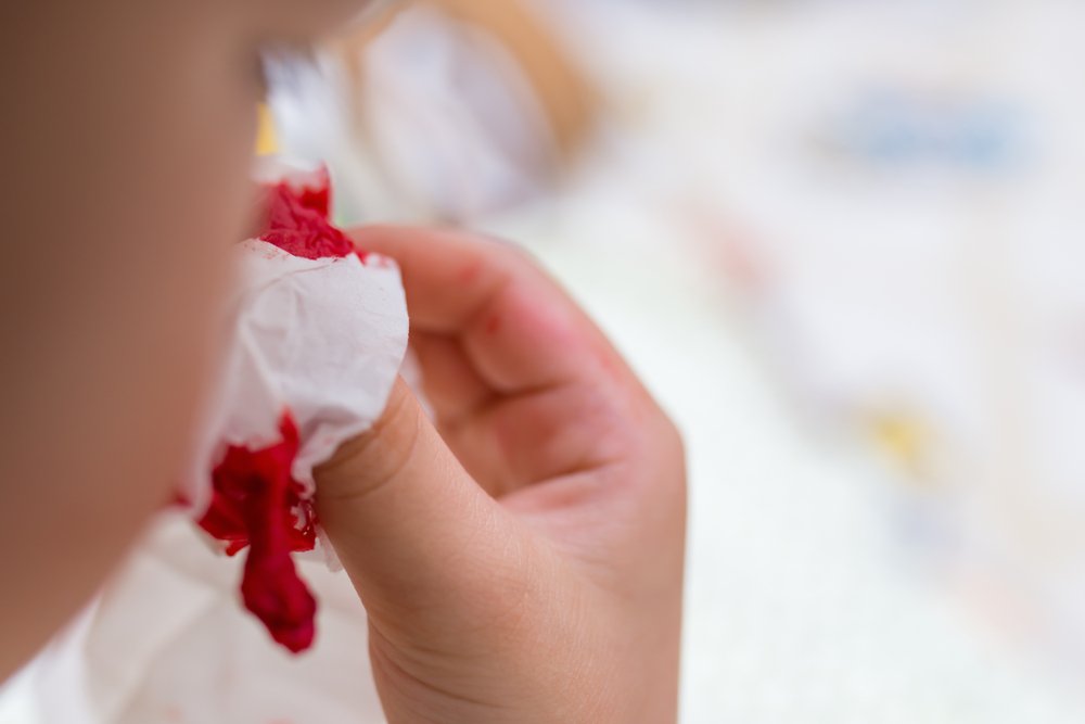 Как остановить носовое кровотечение у ребёнка?