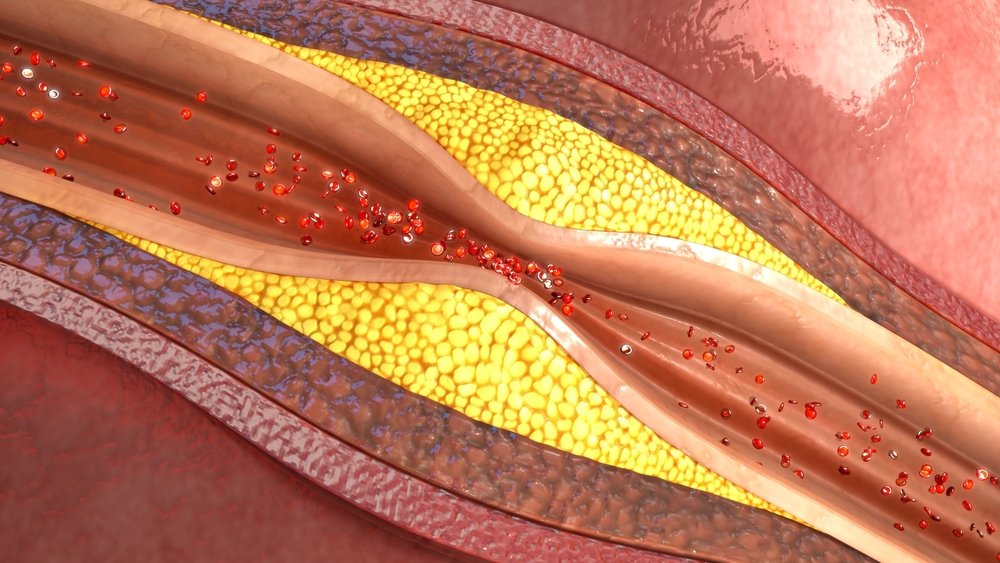 Как проявляется атеросклероз брахиоцефальных артерий?