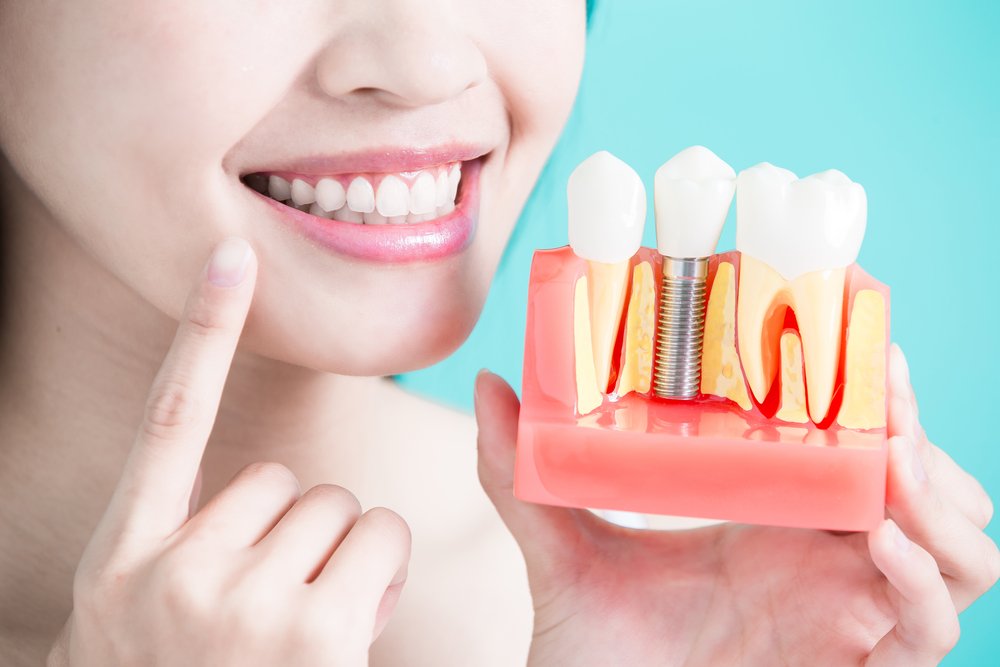 Что такое имплантация зубов «по ключ»?